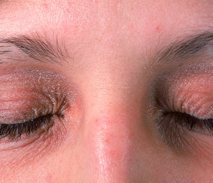 Eczema (Atopic Dermatitis) – Healing Skin, Restoring Peace