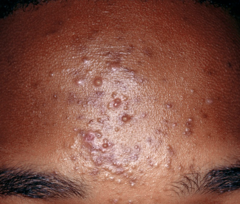 Acne – More Than Breakouts—It’s Time for Real Relief