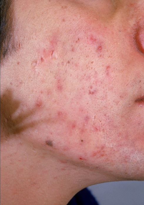 Acne – More Than Breakouts—It’s Time for Real Relief