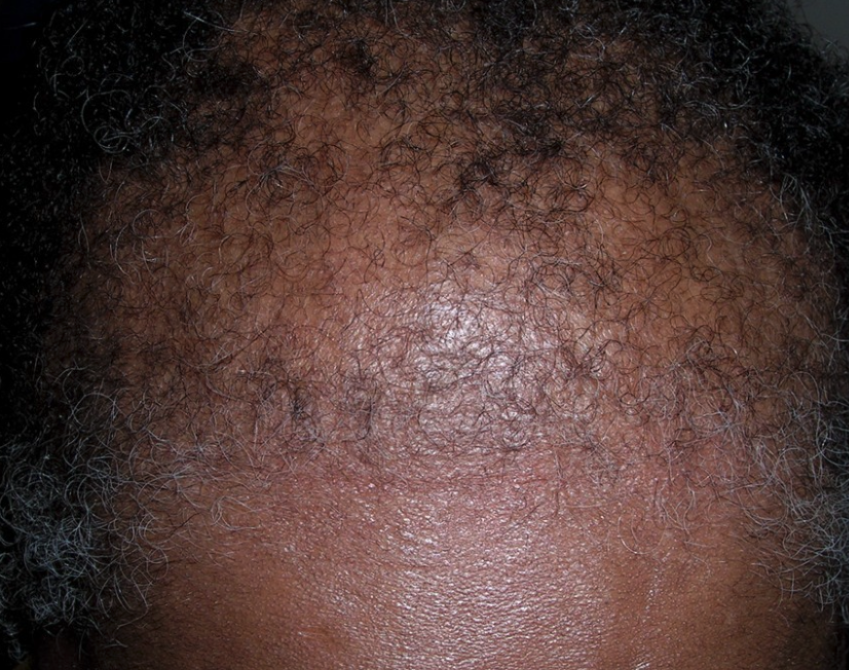 Alopecia (Hair Loss, Thinning & Shedding) – Every Strand Matters—Let’s Get to the Root Cause