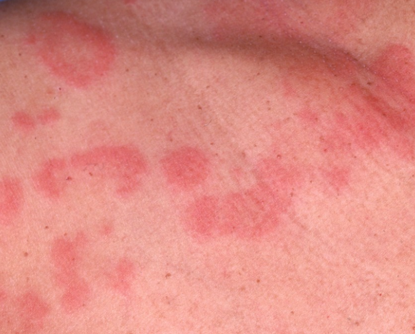 Skin Rashes, Allergies & Hives – Listen to Your Skin—We’ll Help Decode It