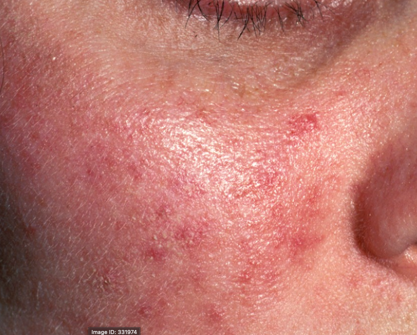 Rosacea – Restore Your Calm, Reclaim Your Confidence