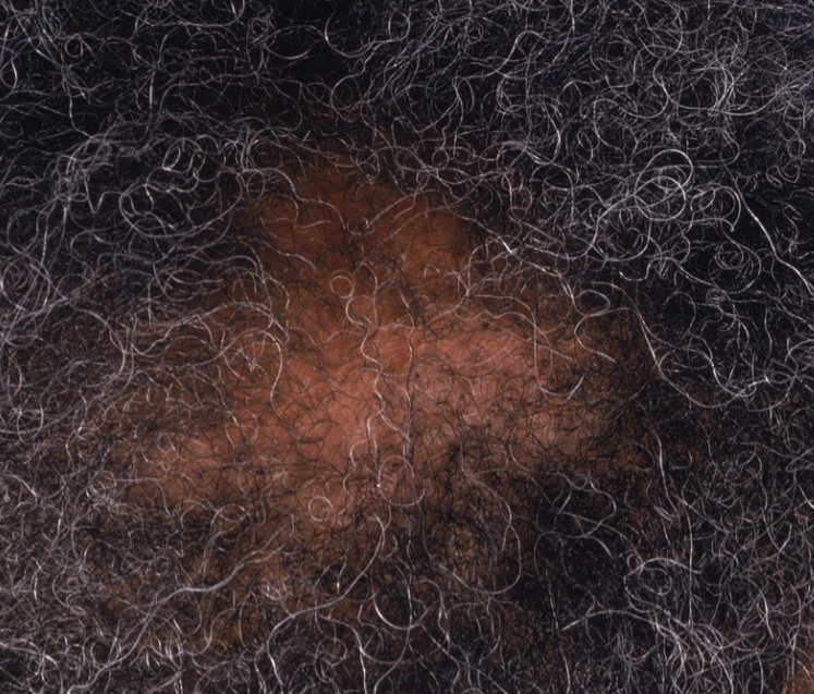 Alopecia (Hair Loss, Thinning & Shedding) – Every Strand Matters—Let’s Get to the Root Cause