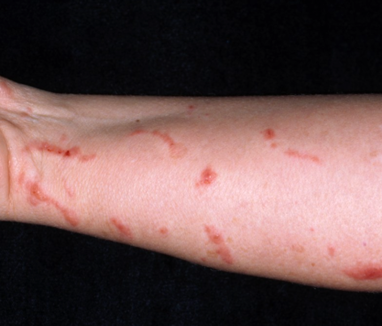 Skin Rashes, Allergies & Hives – Listen to Your Skin—We’ll Help Decode It