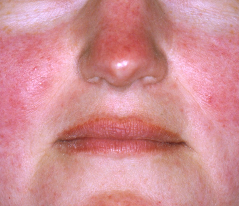 Rosacea – Restore Your Calm, Reclaim Your Confidence