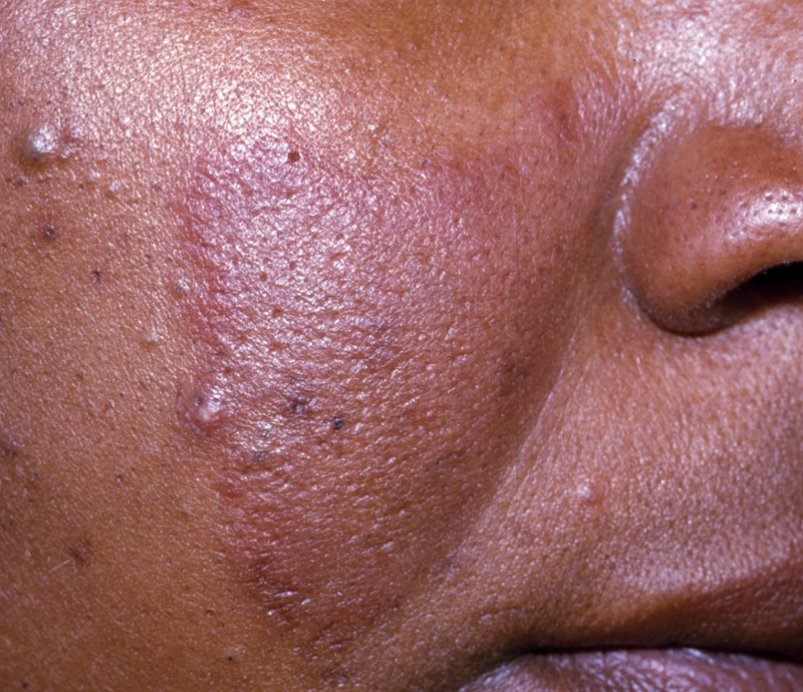 Rosacea – Restore Your Calm, Reclaim Your Confidence