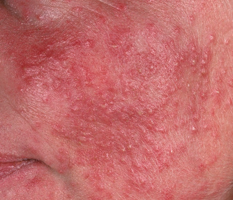 Rosacea – Restore Your Calm, Reclaim Your Confidence