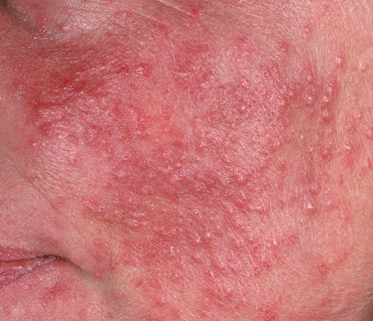 Rosacea – Restore Your Calm, Reclaim Your Confidence