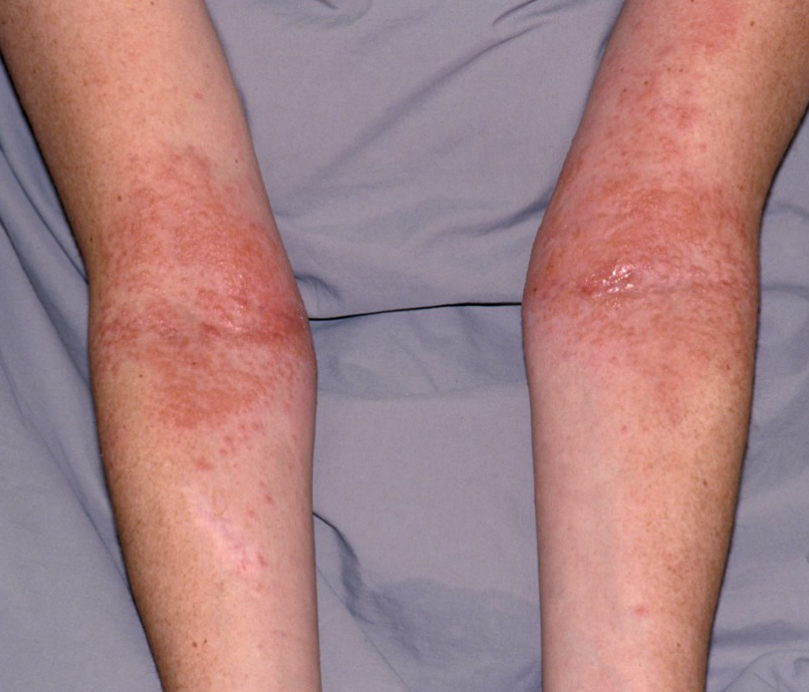 Eczema (Atopic Dermatitis) – Healing Skin, Restoring Peace