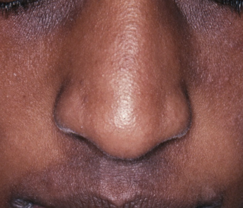 Eczema (Atopic Dermatitis) – Healing Skin, Restoring Peace