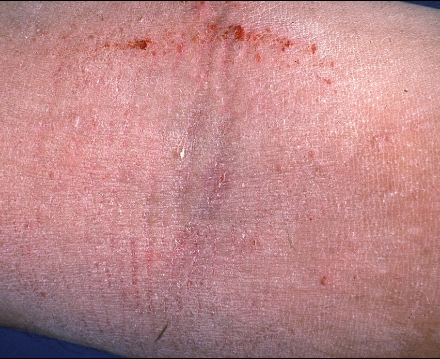 Eczema (Atopic Dermatitis) – Healing Skin, Restoring Peace