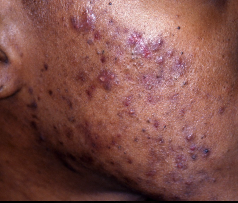 Acne – More Than Breakouts—It’s Time for Real Relief