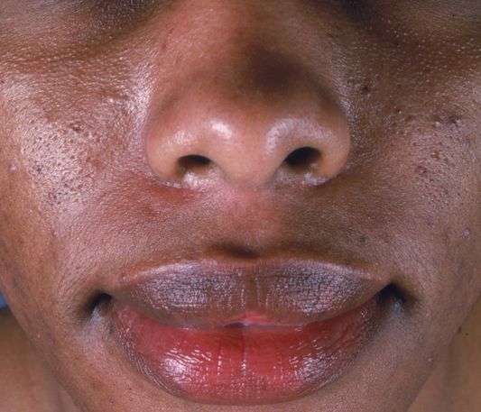 Acne – More Than Breakouts—It’s Time for Real Relief