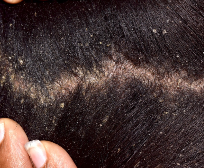 Dandruff / Sebborheic Dermatitis - Putting an end to your Skin's Struggle