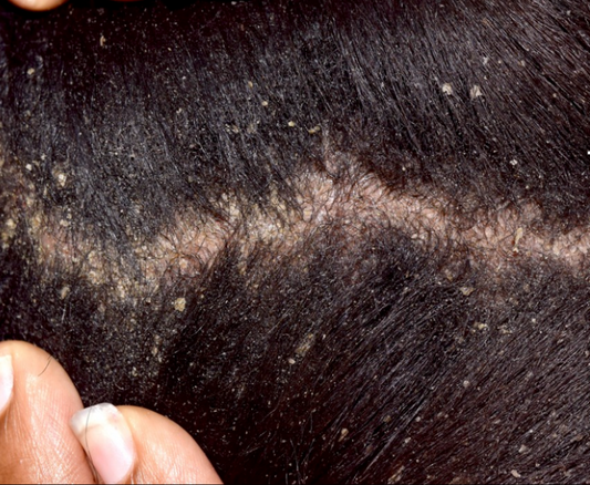Dandruff / Sebborheic Dermatitis - Putting an end to your Skin's Struggle