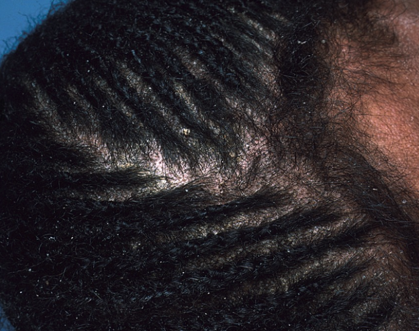 Dandruff / Sebborheic Dermatitis - Putting an end to your Skin's Struggle