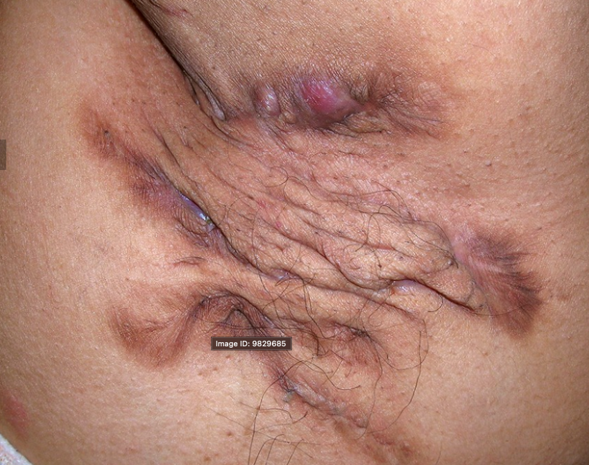 Hidradenitis Suppurativa / Boils - You are not Alone