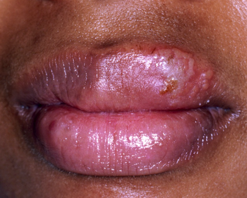 Cold Sores / Herpes/Shingles – You’re Not Alone. Let’s Break the Cycle.