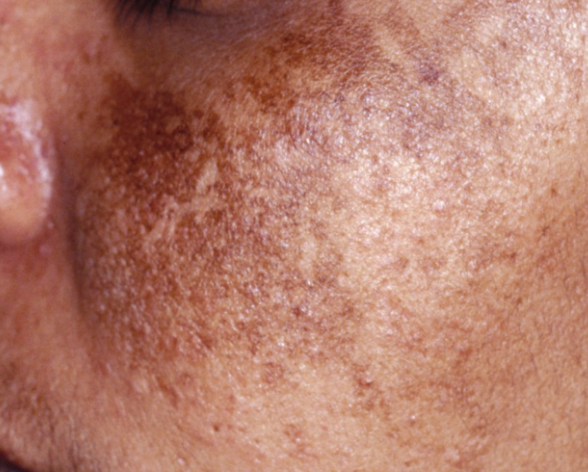 Hyperpigmentation & Melasma – Even Out Your Skin. Reclaim Your Radiance.