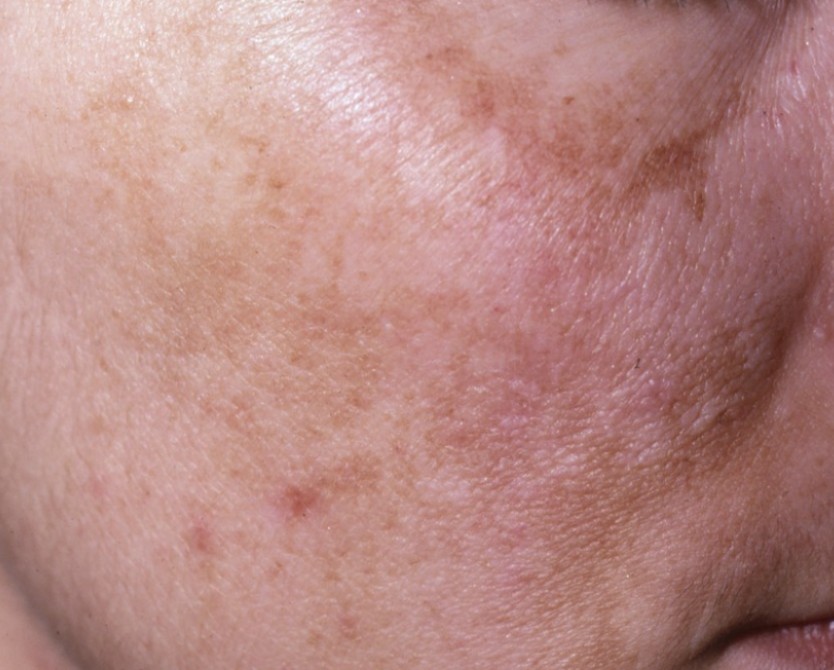 Hyperpigmentation & Melasma – Even Out Your Skin. Reclaim Your Radiance.