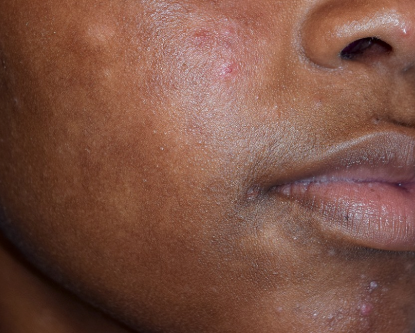Rosacea – Restore Your Calm, Reclaim Your Confidence