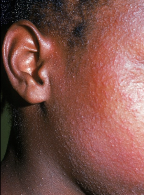Eczema (Atopic Dermatitis) – Healing Skin, Restoring Peace
