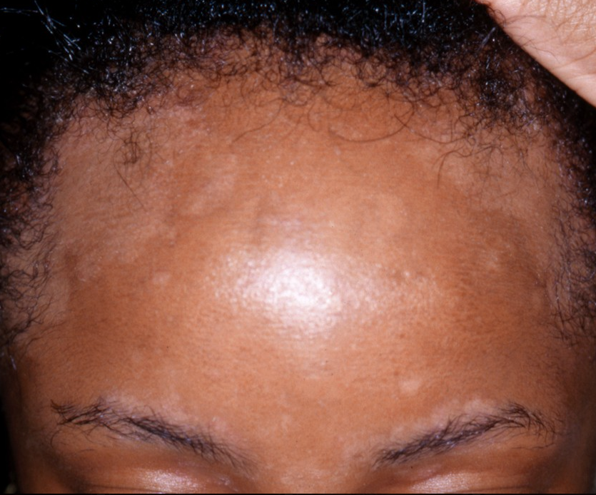 Dandruff / Sebborheic Dermatitis - Putting an end to your Skin's Struggle