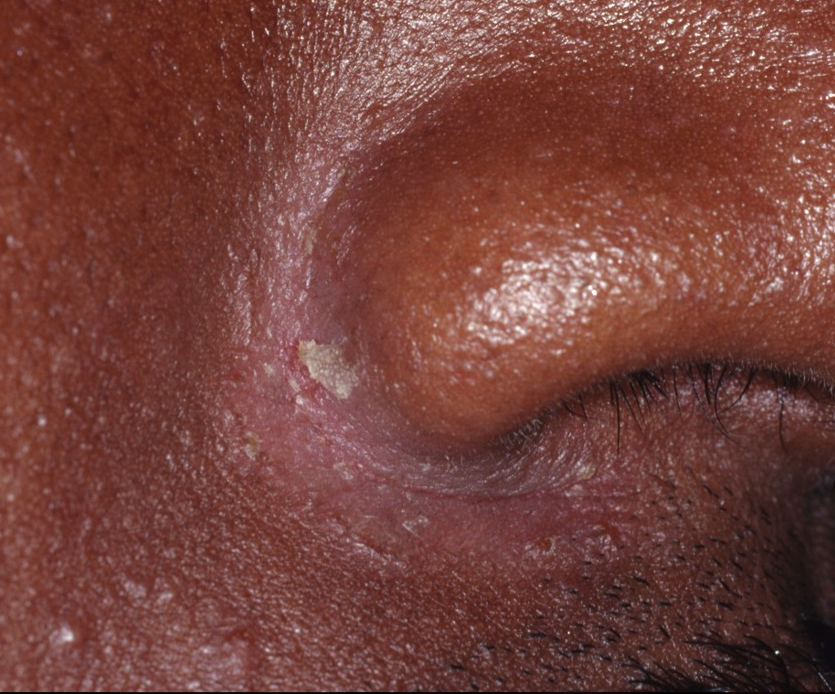 Dandruff / Sebborheic Dermatitis - Putting an end to your Skin's Struggle