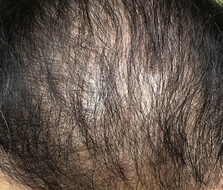 Alopecia (Hair Loss, Thinning & Shedding) – Every Strand Matters—Let’s Get to the Root Cause