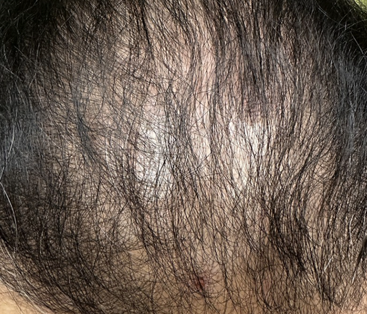 Alopecia (Hair Loss, Thinning & Shedding) – Every Strand Matters—Let’s Get to the Root Cause