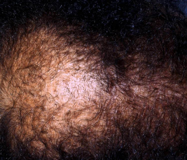 Alopecia (Hair Loss, Thinning & Shedding) – Every Strand Matters—Let’s Get to the Root Cause
