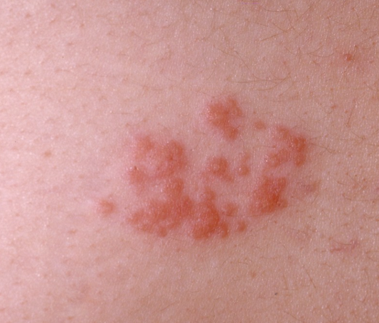 Cold Sores / Herpes/Shingles – You’re Not Alone. Let’s Break the Cycle.