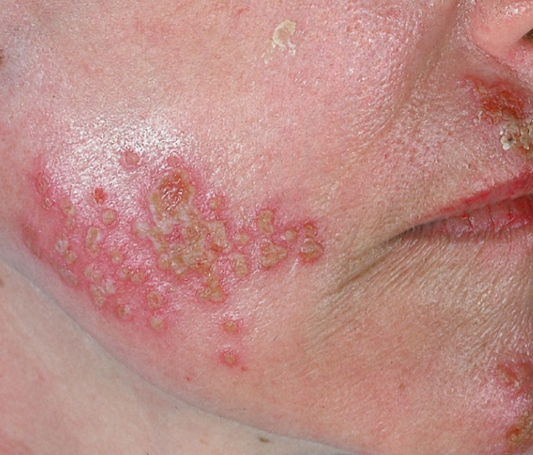 Cold Sores / Herpes/Shingles – You’re Not Alone. Let’s Break the Cycle.