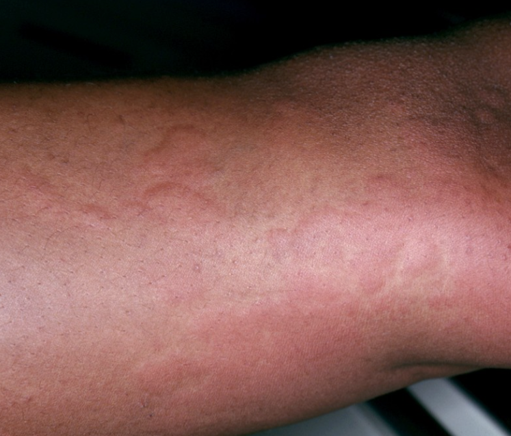 Skin Rashes, Allergies & Hives – Listen to Your Skin—We’ll Help Decode It
