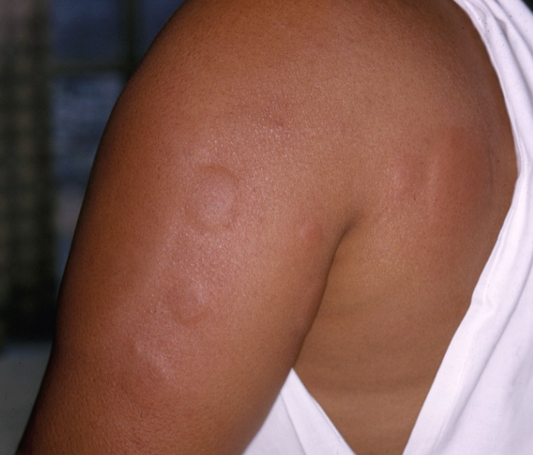 Skin Rashes, Allergies & Hives – Listen to Your Skin—We’ll Help Decode It