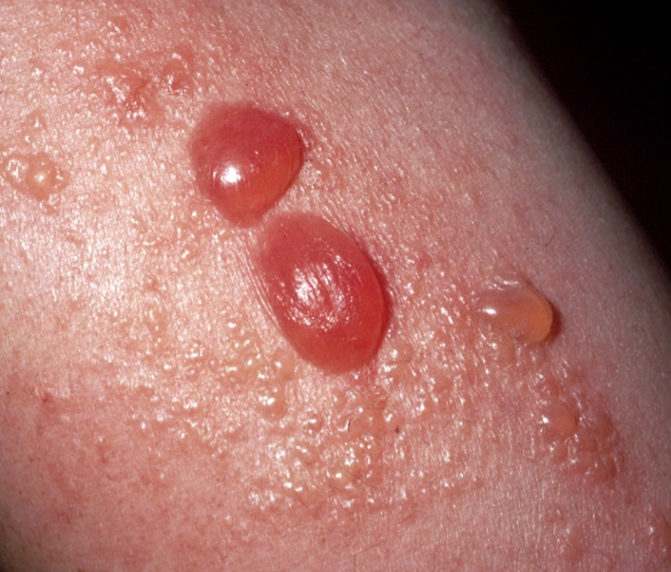 Skin Rashes, Allergies & Hives – Listen to Your Skin—We’ll Help Decode It