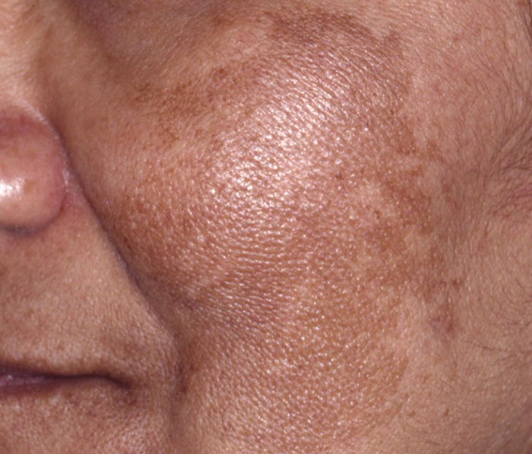 Hyperpigmentation & Melasma – Even Out Your Skin. Reclaim Your Radiance.