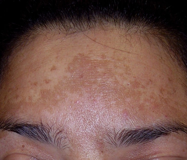 Hyperpigmentation & Melasma – Even Out Your Skin. Reclaim Your Radiance.
