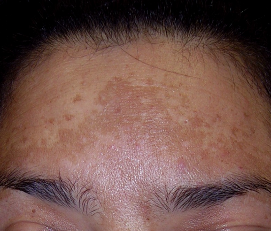 Hyperpigmentation & Melasma – Even Out Your Skin. Reclaim Your Radiance.