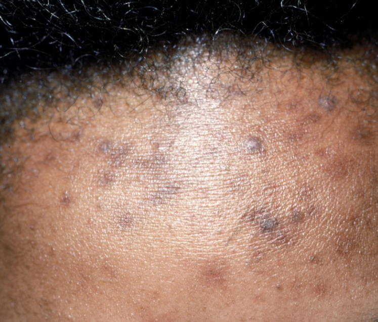 Hyperpigmentation & Melasma – Even Out Your Skin. Reclaim Your Radiance.