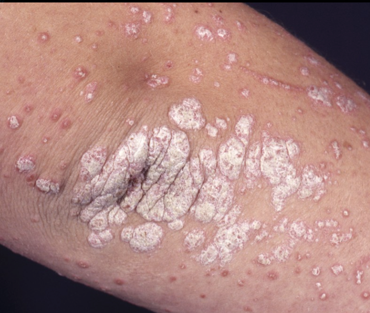 Psoriasis – Break the Cycle—Your Skin Deserves Calm