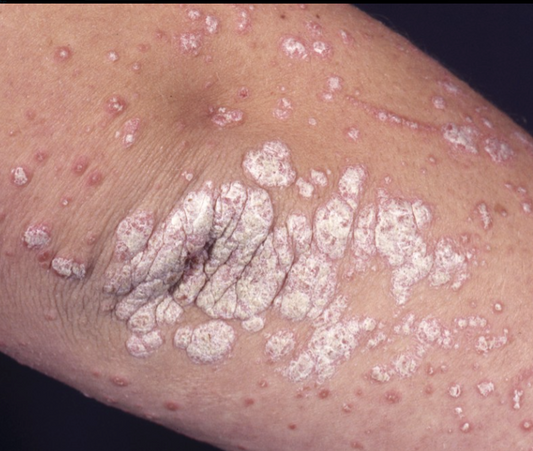 Psoriasis – Break the Cycle—Your Skin Deserves Calm