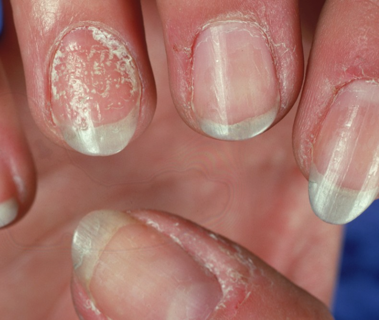 Psoriasis – Break the Cycle—Your Skin Deserves Calm