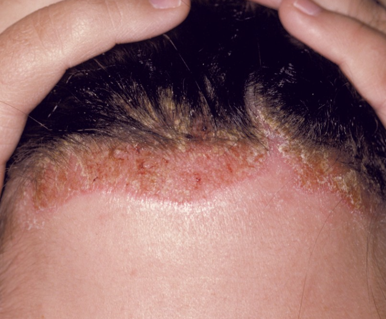 Dandruff / Sebborheic Dermatitis - Putting an end to your Skin's Struggle
